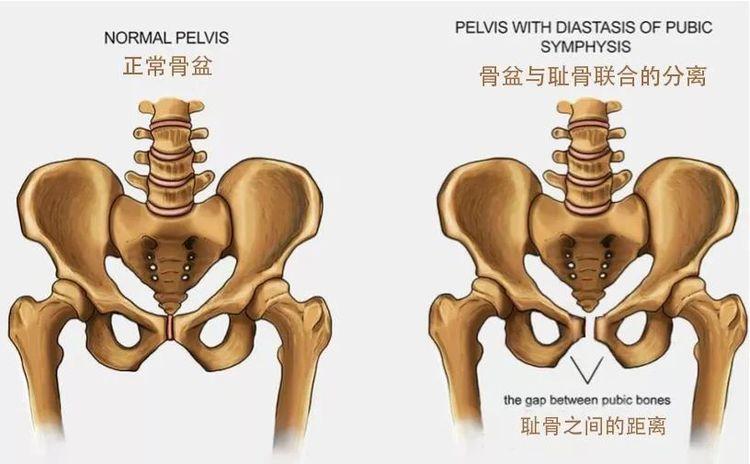 压盆骨视频_骨盆压揉骗局_压骨盆手法